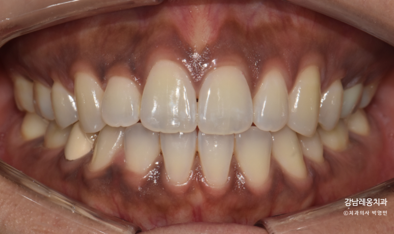 잇몸도 화이트닝이 된다? 까만 잇몸, 착색 잇몸 미백 / 강남레옹치과 관련 이미지 7