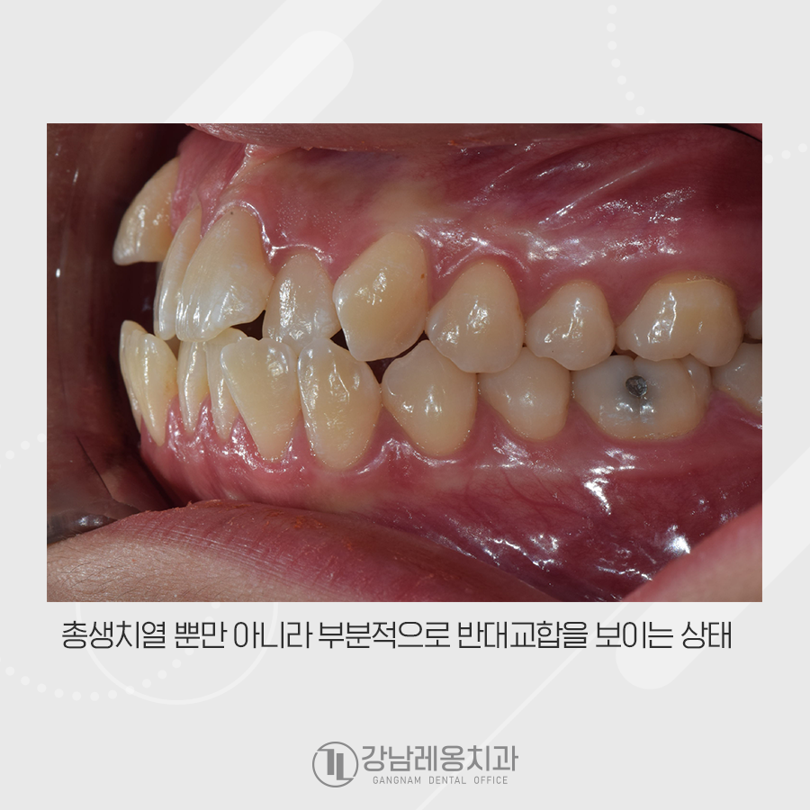 복합적인 구강의 문제를 치아교정으로 해결한 증례 관련 이미지 2