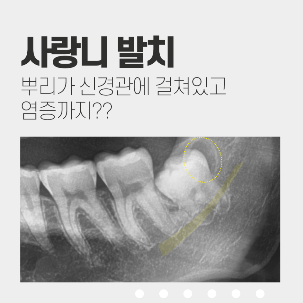 매복 사랑니 뿌리 신경이랑 겹쳐있고 염증까지? 관련 이미지 1