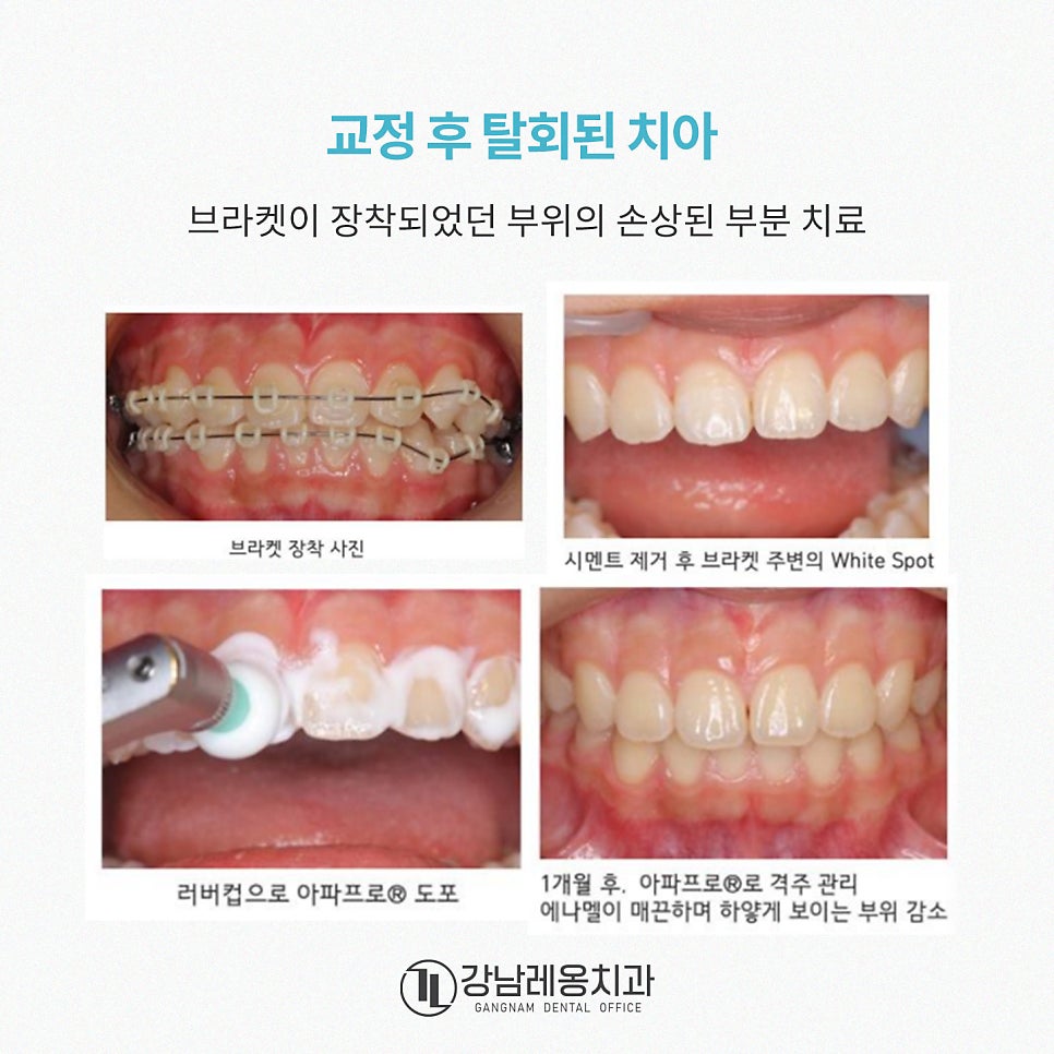 충치예방부터 시린이 완화까지! 아파프로 치아영양제의 5가지 효과✨ / 강남레옹치과 관련 이미지 10