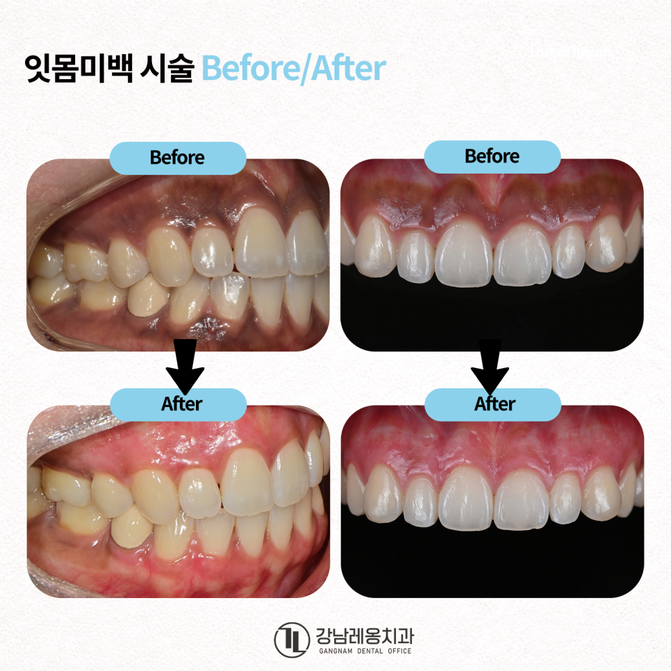Concerned About Dark Gums Showing When You Smile? Gum Whitening Procedure Effects, Duration, and Precautions! / Gangnam Leong Dental New-Teeth Gum Whitening image 4
