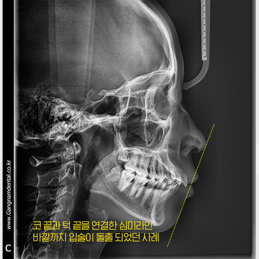 뻐드러진 앞니 각도를 조절하여 돌출입 교정 관련 이미지 2