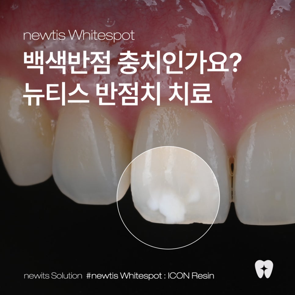 앞니 백색반점, 충치인가요? 충치 vs 백색반점 손상없이 제거 / 아이콘레진 강남레옹치과 관련 이미지 1