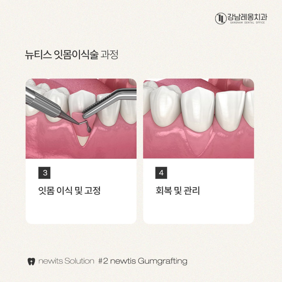 뉴티스 잇몸이식✨ 잇몸퇴축, 치아뿌리를 보호하고 심미적 개선 / 강남레옹치과 관련 이미지 4