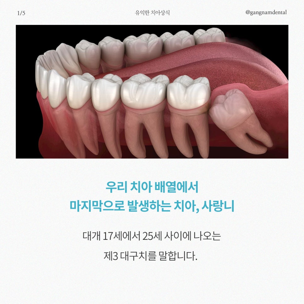 사랑니 발치에 대한 모든것, 사랑니 총정리! / 종류, 비용, 발치과정, 관리, Q&A까지! / 강남레옹치과 관련 이미지 2