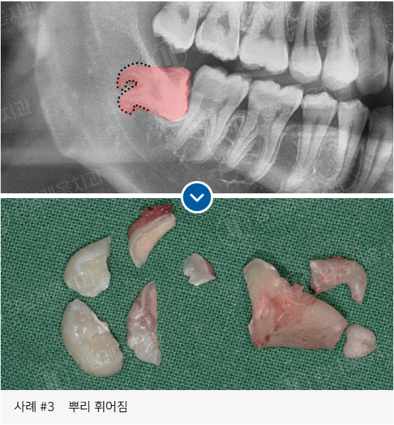 사랑니 발치, 왜 어떤 경우에 대학병원을 권유할까? / 강남레옹치과 관련 이미지 11