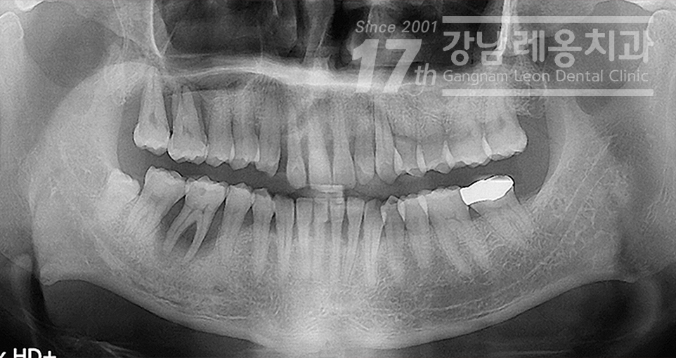올바른 잇솔질이 왜 중요한지 예방중심 강남역치과의 설명 관련 이미지 5