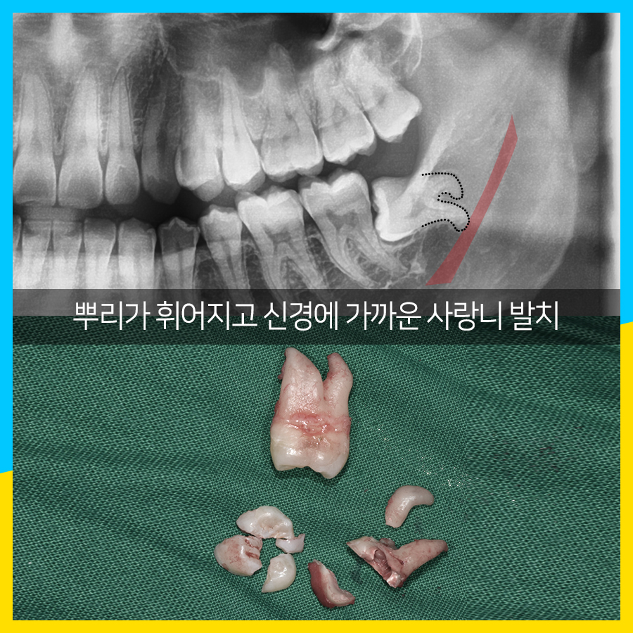 사랑니 발치 뿌리가 휘어졌는데도?? 관련 이미지 4