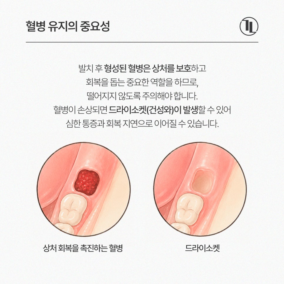 사랑니 발치 후 술&담배 언제 가능? 사랑니 회복 가이드🔖/ 강남레옹치과 관련 이미지 5