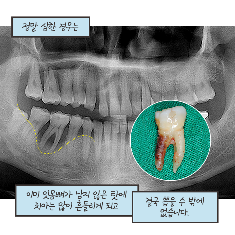 냐폴레옹 치과툰) 스케일링 후 이가 시린 이유가, 치아를 갈아서라고?? 관련 이미지 10