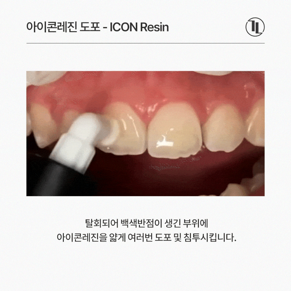 앞니 하얀얼룩 반점치 하루만에 치료, 원인과 사례까지! / 강남레옹치과 관련 이미지 5