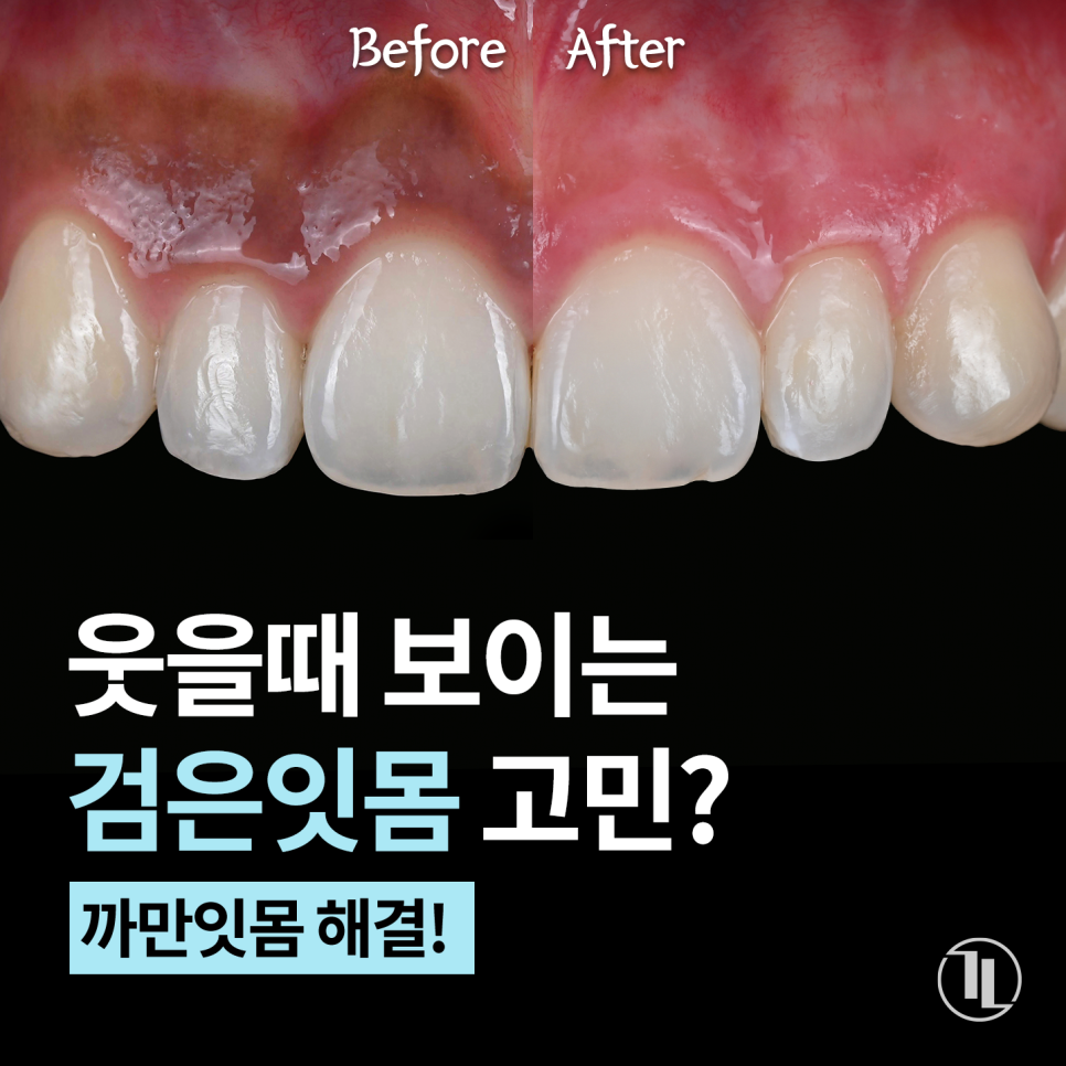 Concerned About Dark Gums Showing When You Smile? Gum Whitening Procedure Effects, Duration, and Precautions! / Gangnam Leong Dental New-Teeth Gum Whitening image 1