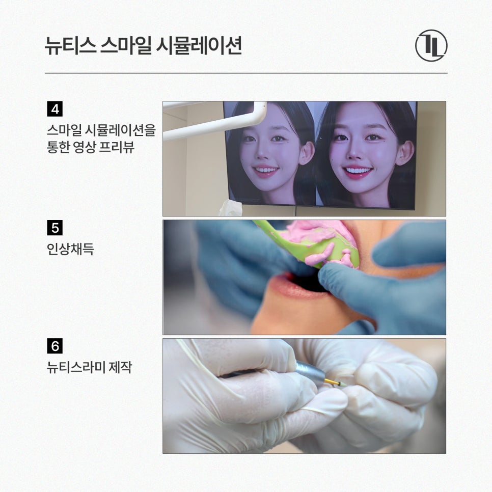 뉴티스 스마일 시뮬레이션 - 시술 전 영상으로 미리 확인하는 내 모습! / 강남레옹치과 관련 이미지 5