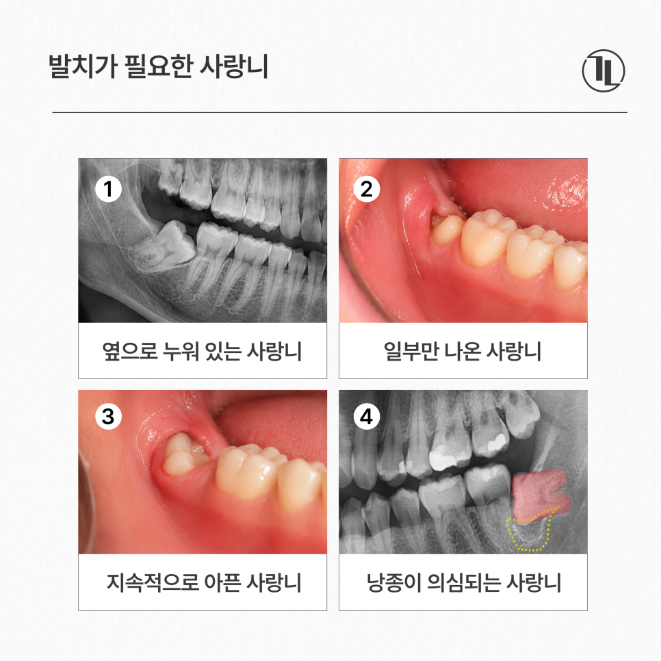 사랑니 안 아픈데 꼭 뽑아야 될까요?발치가 필요한 경우 / 강남레옹치과 관련 이미지 3