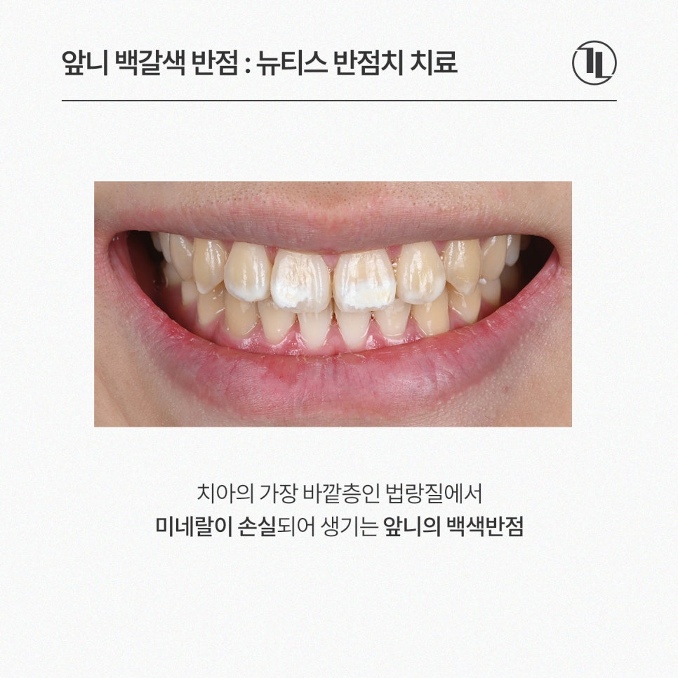 앞니 하얀점, 뉴티스 반점치 제거로 당일 개선 / 강남레옹치과 관련 이미지 2