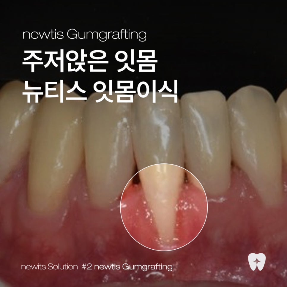 뉴티스 잇몸이식✨ 잇몸퇴축, 치아뿌리를 보호하고 심미적 개선 / 강남레옹치과 관련 이미지 1