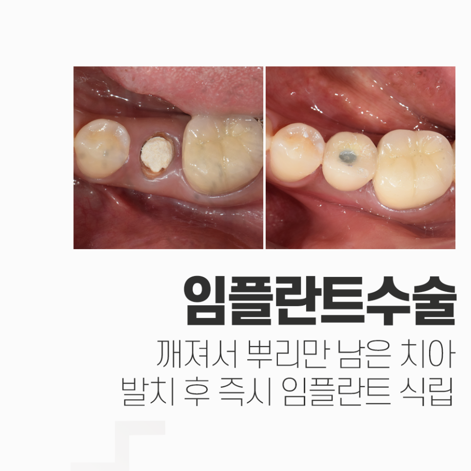 뿌리만 남은 치아, 발치 즉시 임플란트 케이스 관련 이미지 1
