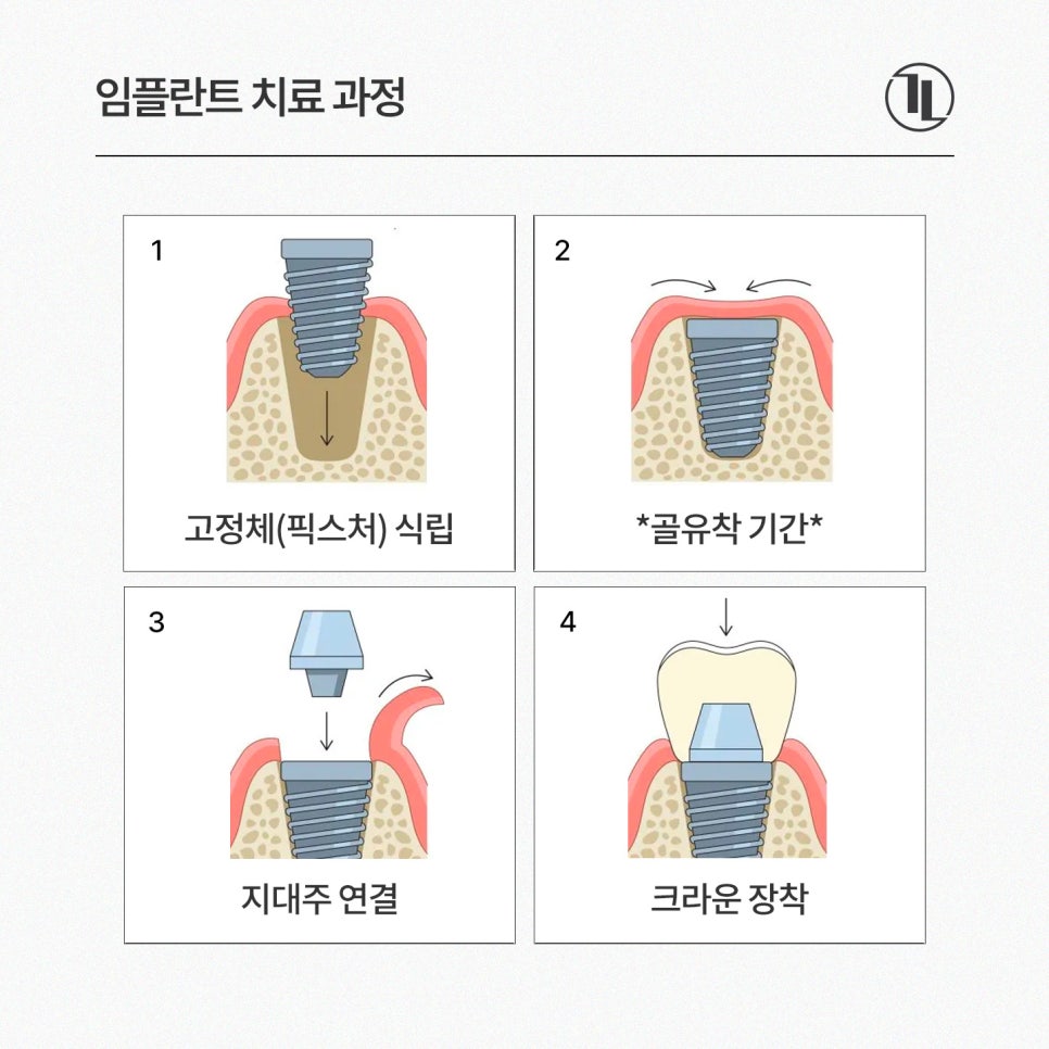 A Complete Guide to National Health Insurance Coverage for Implants / Out-of-Pocket Costs, Number Covered, Treatment Period, Bone Grafting, and FAQs / Gangnam Leon Dental Clinic image 5