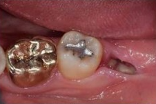 사랑니 발치 후 회복과정 한 눈에 보기🔍 / 강남역 사랑니 강남레옹치과 관련 이미지 8