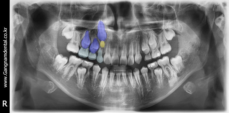 치아가 너무 많으면 생기는 일, 과잉치의 모든 것🦷 / 강남레옹치과 관련 이미지 3