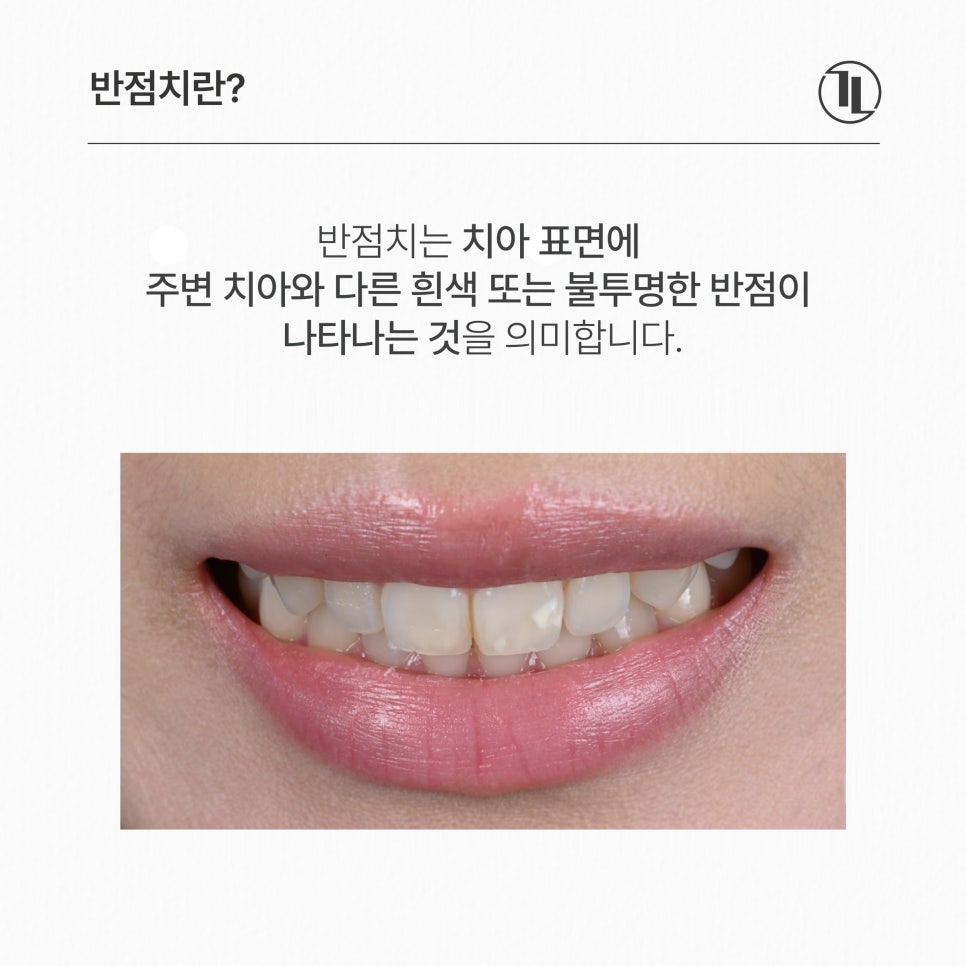 앞니 하얀 얼룩, 반점치 치료 케이스 / 아이콘레진 치료 방법 / 강남레옹치과 관련 이미지 2