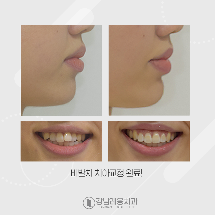 삐뚤빼뚤 앞니 비발치 교정, 옥니가 되지 않게 관련 이미지 5
