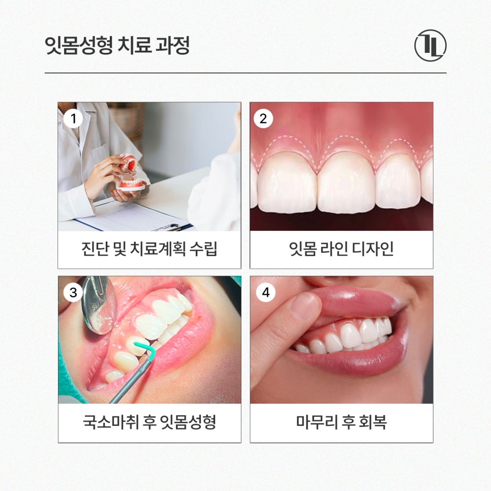 앞니 잇몸 라인이 들쭉날쭉하다면? 잇몸성형 치료 과정부터 회복 기간&middot;주의 사항까지 / 강남레옹치과 관련 이미지 4