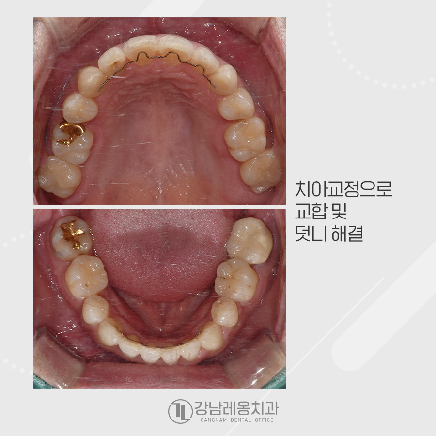발치 치아교정, 덧니 총생 반대교합까지 한번에 해결 관련 이미지 4