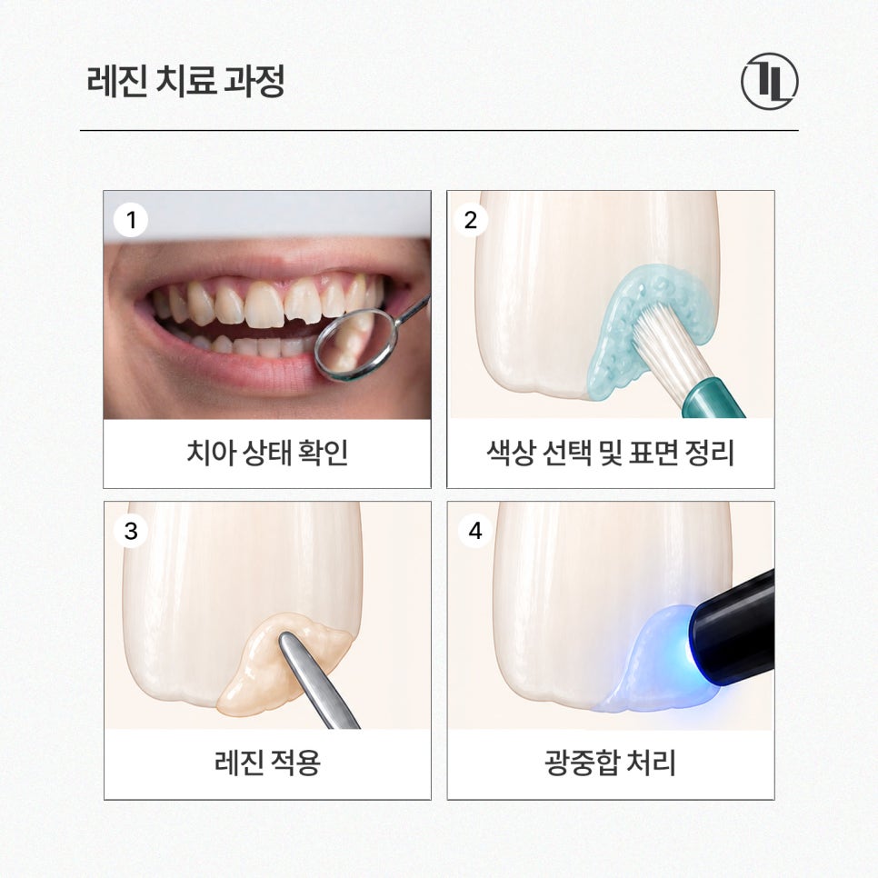 앞니 깨짐 레진치료 가능한 경우 / 레진치료 사례와 과정 / 강남레옹치과 관련 이미지 3