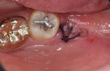 사랑니 발치 후 회복과정 한 눈에 보기🔍 / 강남역 사랑니 강남레옹치과 관련 이미지 5