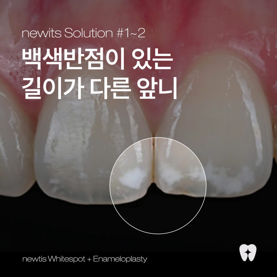 앞니에 하얀얼룩이? 앞니 길이가 달라요! / 앞니통합치료 뉴티스 반점치료 + 치아성형✨ / 강남레옹치과 관련 이미지 1