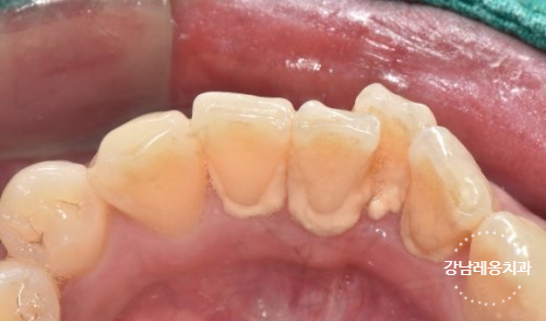 치아 스케일링 후 이시림 / 식사는? / 강남레옹치과 관련 이미지 2