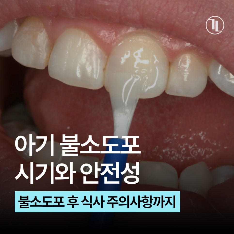 아기 불소도포 시기, 주기, 안정성 총정리 한눈에 보기🧐 / 강남레옹치과 관련 이미지 1