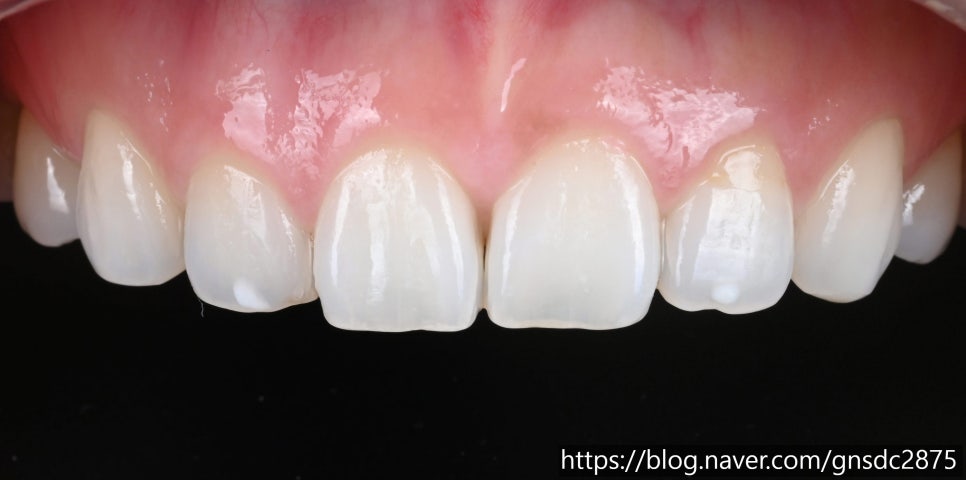 뉴티스 반점치 치료✨ 최다 임상적용, 반점치 제거 아이콘레진 / 강남레옹치과 관련 이미지 2