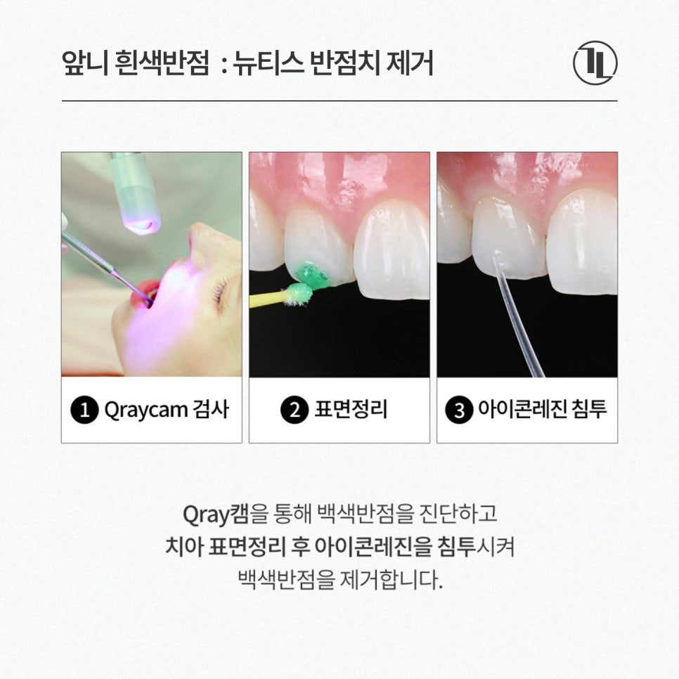 깨지고 하얗게 얼룩진 앞니, 라미네이트 대신 뉴티스 솔루션 / 강남레옹치과 관련 이미지 5