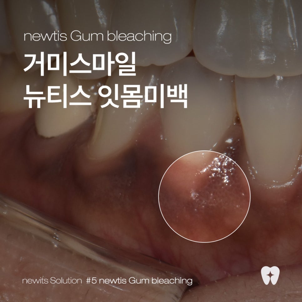 뉴티스 잇몸미백✨ 웃을 때 드러나는 검은 잇몸 개선 / 강남레옹치과 관련 이미지 1
