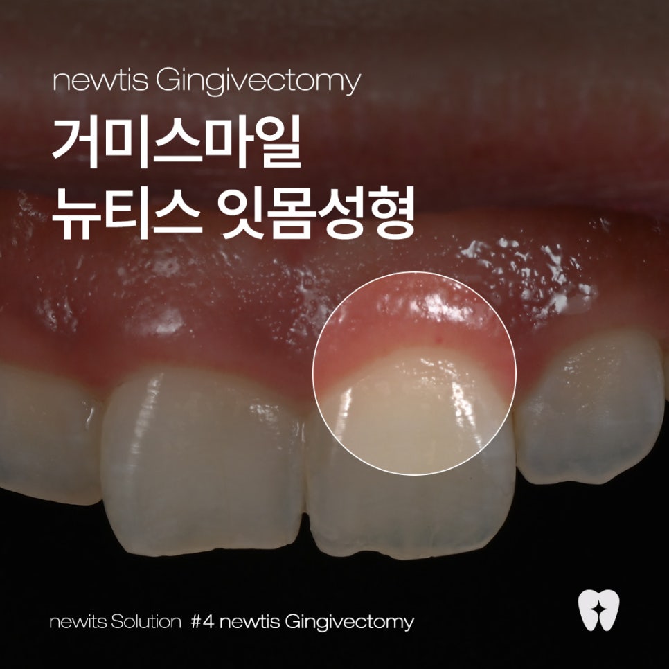 뉴티스 잇몸성형✨ 거미스마일 원인과 해결법, 잇몸성형으로 가능한가요? / 강남레옹치과 관련 이미지 1