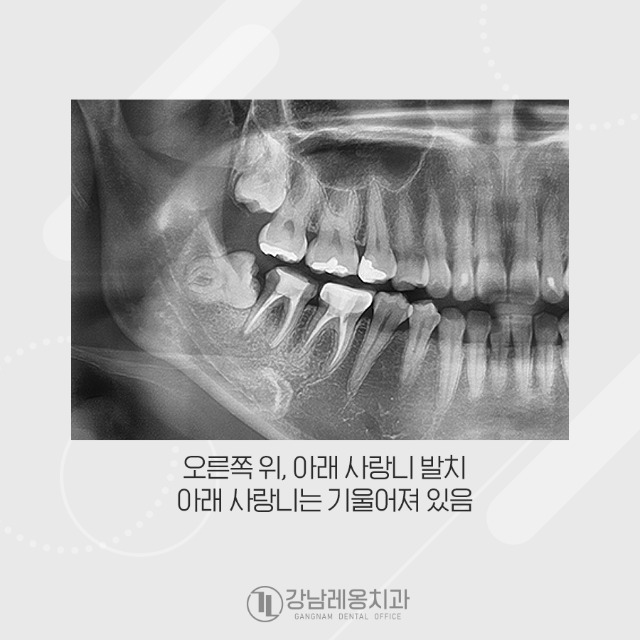 누운 사랑니 발치 통증 없이 깨끗하게 아물었던 강남레옹치과 증례 관련 이미지 2