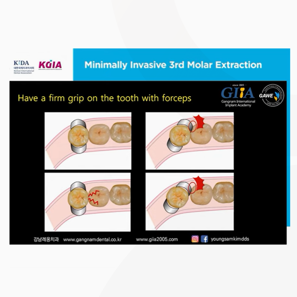 대한국제치과의사회 웨비나 김영삼원장님 강연, 독일 IDS 2021 관련 이미지 4