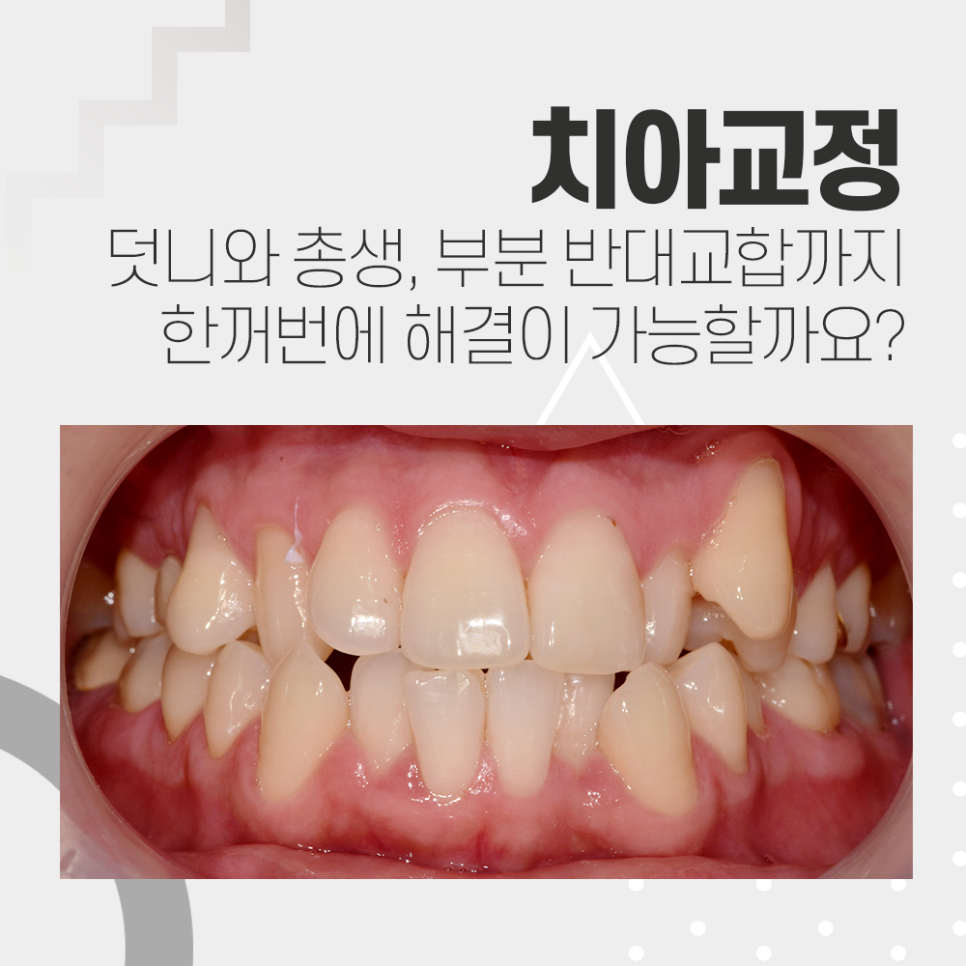 발치 치아교정, 덧니 총생 반대교합까지 한번에 해결 관련 이미지 1