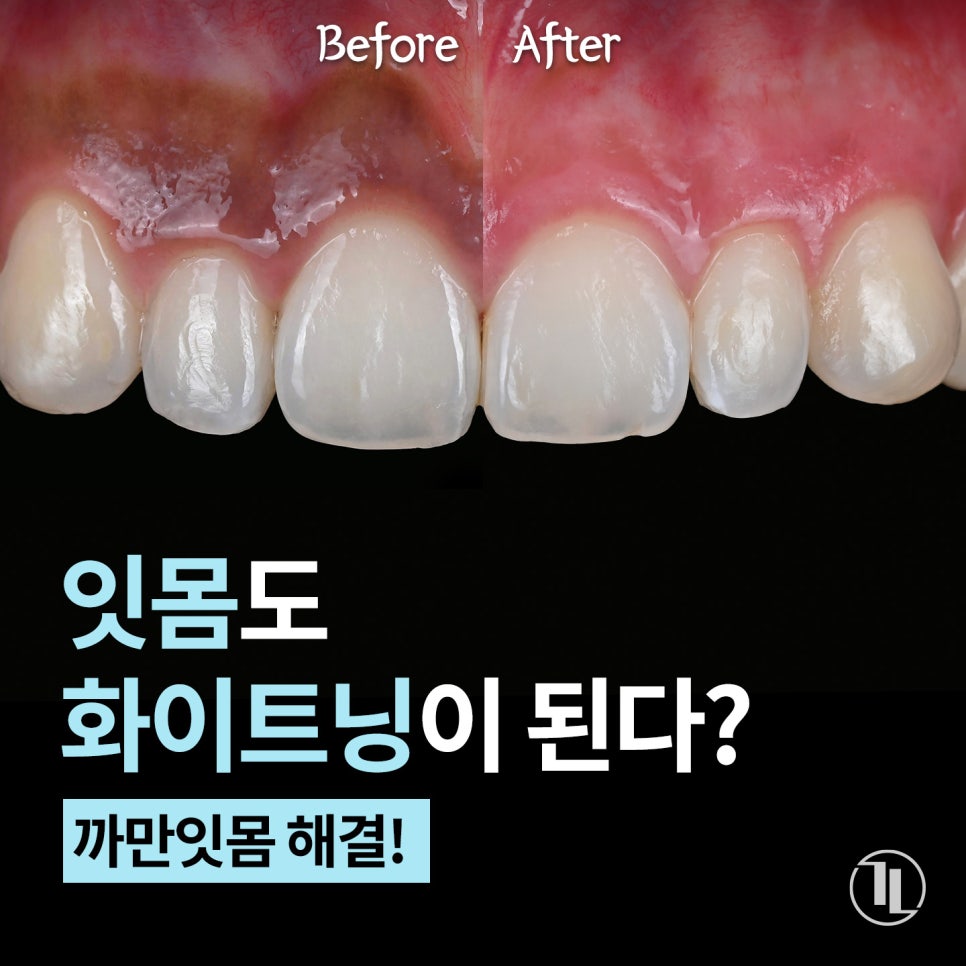 잇몸도 화이트닝이 된다? 까만 잇몸, 착색 잇몸 미백 / 강남레옹치과 관련 이미지 1