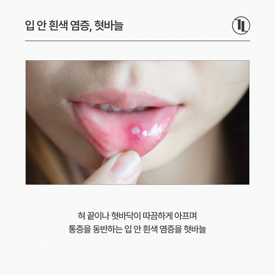 입안 피물집, 물혹, 혓바늘, 혀돌기(유두종) 원인 및 치료 / 강남레옹치과 관련 이미지 4