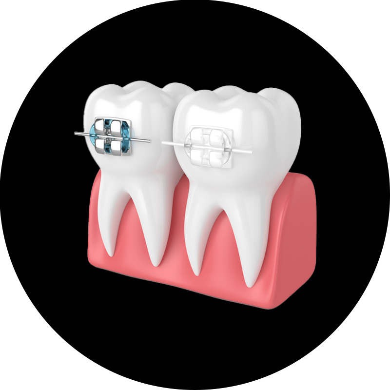 앞니 벌어짐 치료 후기 / 아이 앞니 벌어짐 건강하게 치료하려면? / 강남레옹치과 관련 이미지 6