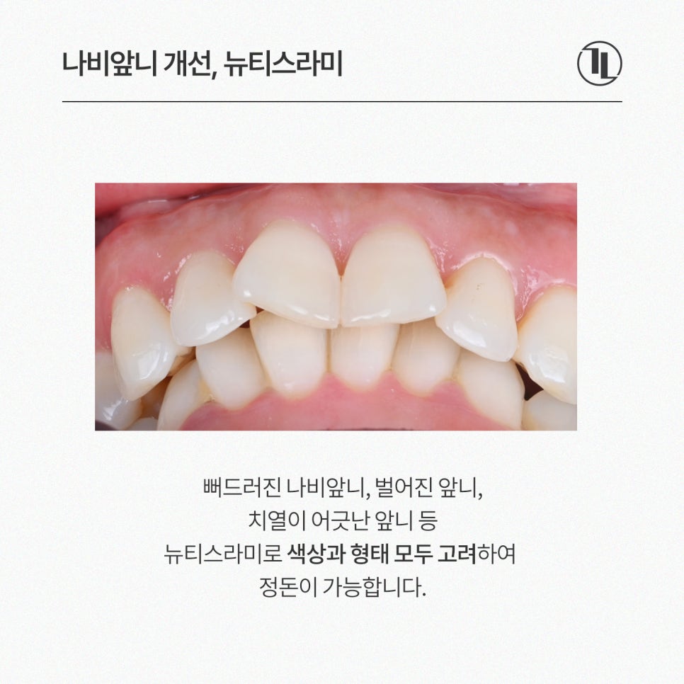 뻐드러진 나비앞니, 시술 전 스마일 시뮬레이션 후 뉴티스라미 관련 이미지 2