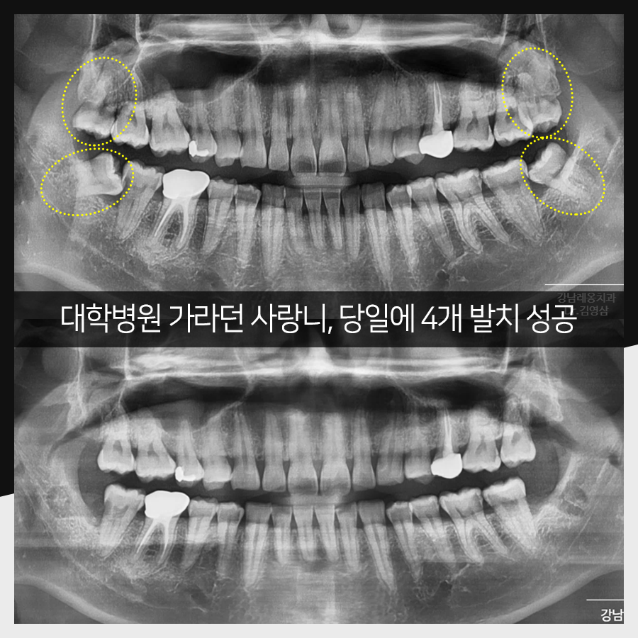 강남레옹치과 사랑니 발치, 결과가 증명해주는 실력! 관련 이미지 25