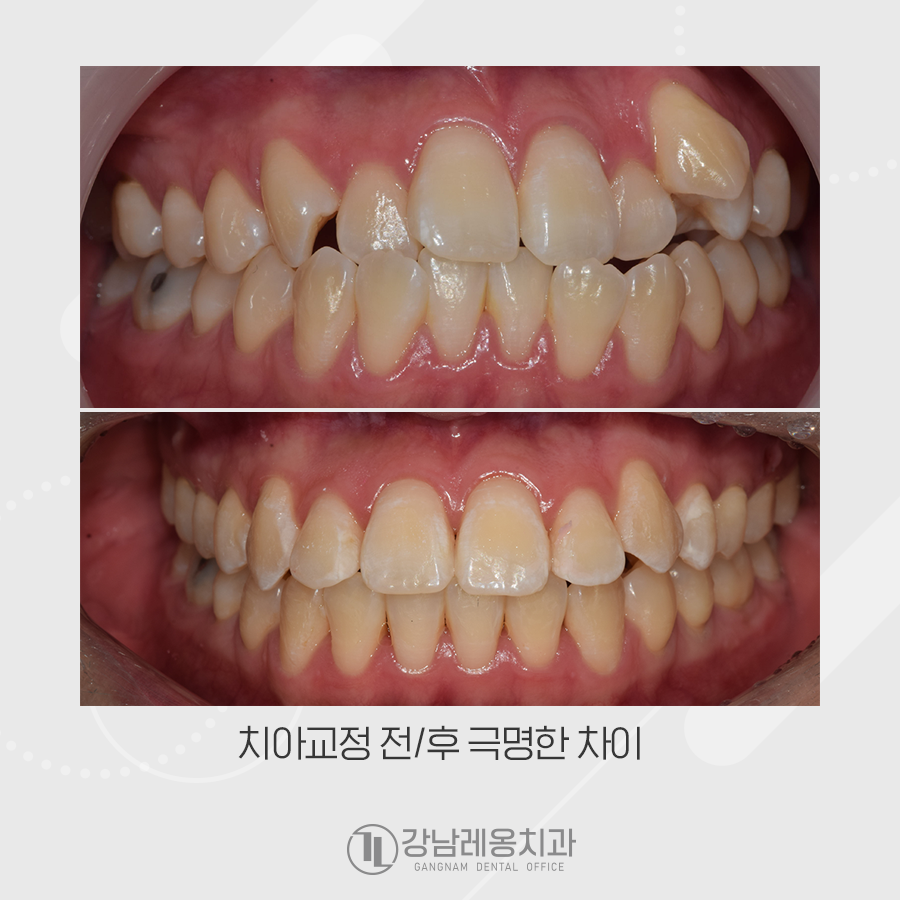 복합적인 구강의 문제를 치아교정으로 해결한 증례 관련 이미지 4