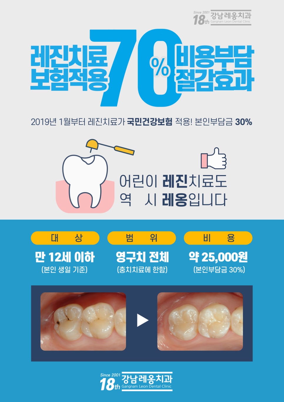 강남레옹치과 레진치료도 건강보험에 적용되었어요! 12세 이하 어린이 영구치 관련 이미지 7