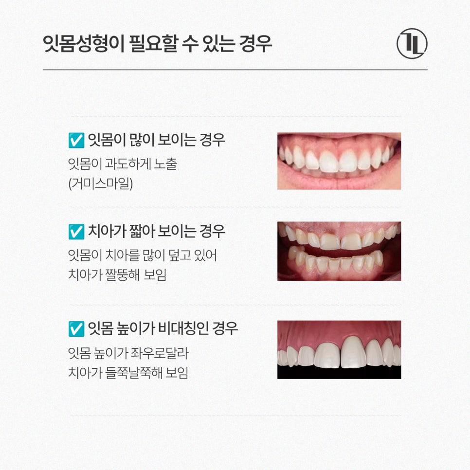 앞니 잇몸 라인이 들쭉날쭉하다면? 잇몸성형 치료 과정부터 회복 기간&middot;주의 사항까지 / 강남레옹치과 관련 이미지 3