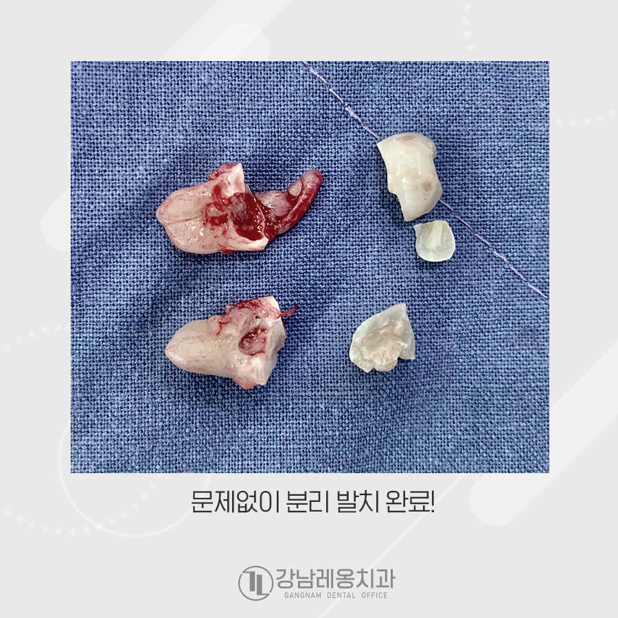 교정 중 수평매복사랑니 발치, 강남레옹치과에서 관련 이미지 4