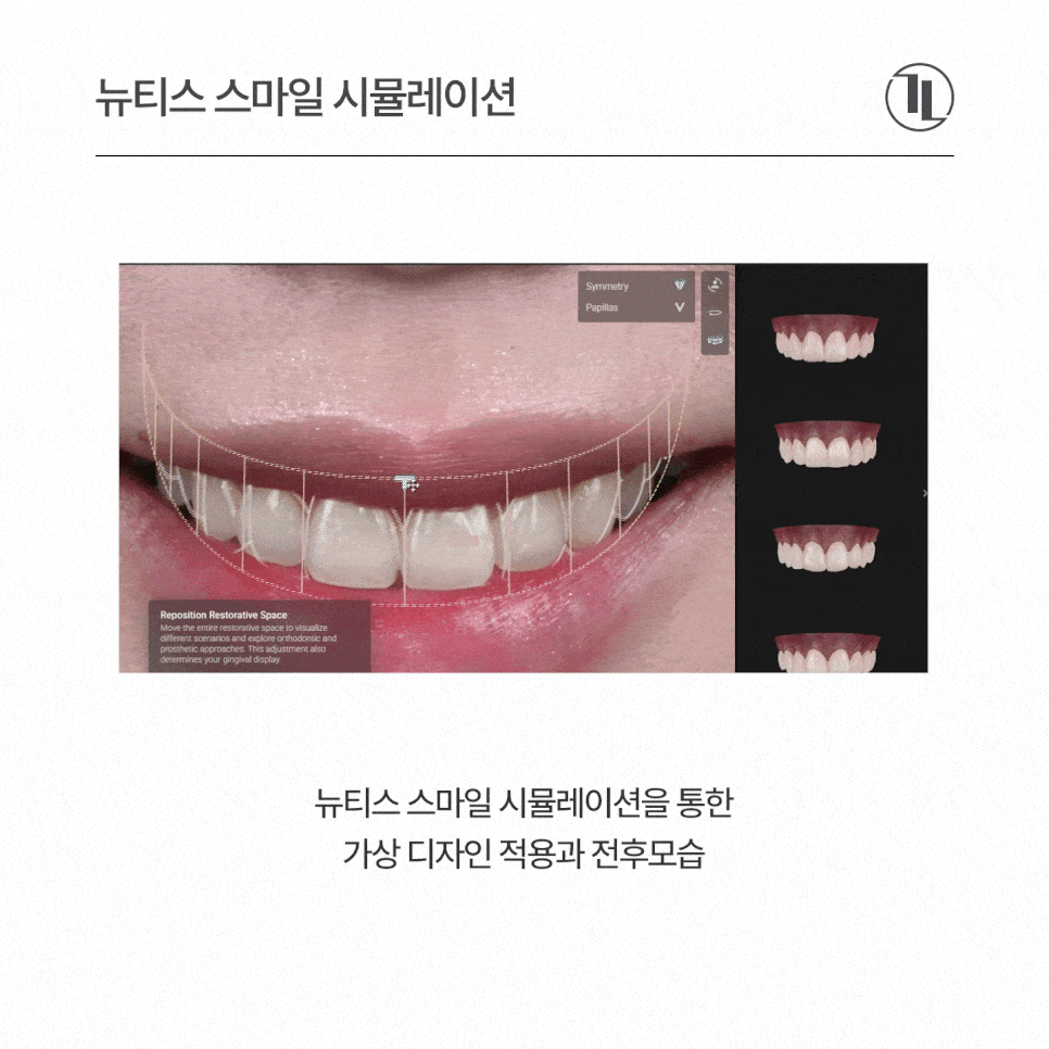 뉴티스 스마일 시뮬레이션 - 시술 전 영상으로 미리 확인하는 내 모습! / 강남레옹치과 관련 이미지 7